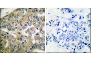 Immunohistochemistry analysis of paraffin-embedded human breast carcinoma tissue, using FHIT Antibody. (FHIT anticorps  (AA 81-130))