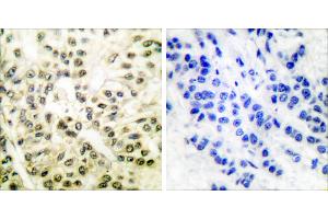 Peptide - +Immunohistochemical analysis of paraffin-embedded human breast carcinoma tissue using CREB (Ab-129/133) antibody (#B7053). (CREB1 anticorps  (Ser129, Ser133))