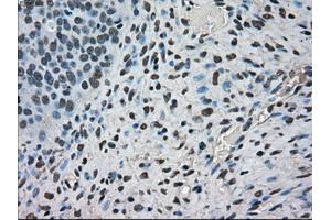 Immunohistochemical staining of paraffin-embedded Carcinoma of kidney tissue using anti-FERMT2mouse monoclonal antibody. (FERMT2 anticorps)