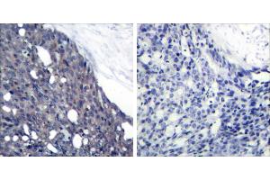Peptide - +Immunohistochemical analysis of paraffin-embedded human breast carcinoma tissue using IκB-α (Ab-42) antibody (#B7116). (NFKBIA anticorps  (Tyr42))