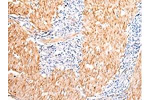 The image on the left is immunohistochemistry of paraffin-embedded Human gastric cancer tissue using ABIN7190483(DMBT1 Antibody) at dilution 1/20, on the right is treated with synthetic peptide. (DMBT1 anticorps)