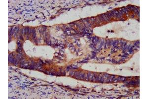 IHC image of ABIN7145547 diluted at 1:1200 and staining in paraffin-embedded human colon cancer performed on a Leica BondTM system. (BID anticorps  (AA 1-195))