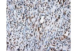Immunohistochemical staining of paraffin-embedded Carcinoma of liver tissue using anti-FAHD2A mouse monoclonal antibody. (FAHD2A anticorps)
