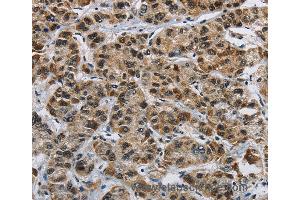Immunohistochemistry of Human liver cancer using HNRNPL Polyclonal Antibody at dilution of 1:40 (HNRNPL anticorps)