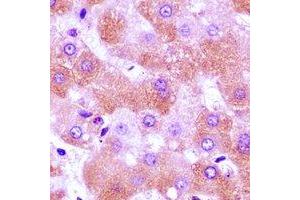 Immunohistochemical analysis of FURIN staining in human liver cancer formalin fixed paraffin embedded tissue section. (FURIN anticorps)