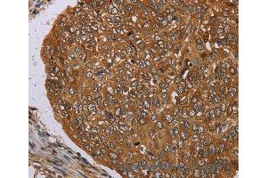 Immunohistochemistry of Human esophagus cancer using PIM3 Polyclonal Antibody at dilution of 1:35 (PIM3 anticorps)