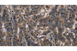 Immunohistochemistry of paraffin-embedded Human liver cancer tissue using FGF18 Polyclonal Antibody at dilution 1:40 (FGF18 anticorps)