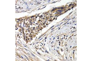 Immunohistochemistry of paraffin-embedded human esophagus cancer using FZR1 antibody (ABIN5973232) at dilution of 1/200 (40x lens). (FZR1 anticorps)