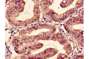 Immunohistochemistry of paraffin-embedded human endometrial cancer using ABIN7152013 at dilution of 1:100 (EPO anticorps  (AA 28-191))