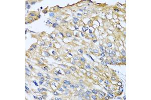Immunohistochemistry of paraffin-embedded human prostate cancer using CCL8 antibody (ABIN5975074) at dilution of 1/100 (40x lens). (CCL8 anticorps)