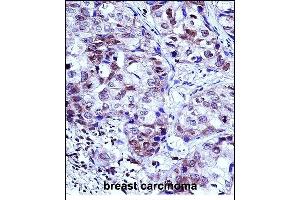 HIST1H1D Antibody (Center) (ABIN657667 and ABIN2846660) immunohistochemistry analysis in formalin fixed and paraffin embedded human breast carcinoma followed by peroxidase conjugation of the secondary antibody and DAB staining. (Histone H1.3 anticorps  (AA 135-164))