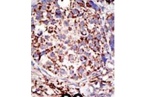 Formalin-fixed and paraffin-embedded human cancer tissue reacted with the primary antibody, which was peroxidase-conjugated to the secondary antibody, followed by DAB staining. (USP3 anticorps  (C-Term))