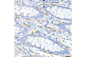 Immunohistochemistry of paraffin-embedded human liver cancer using LPP Rabbit mAb (ABIN7268284) at dilution of 1:100 (40x lens). (LPP anticorps)