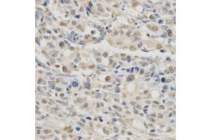 Immunohistochemistry of paraffin-embedded human gastric cancer using SPHK1 Antibody. (SPHK1 anticorps)