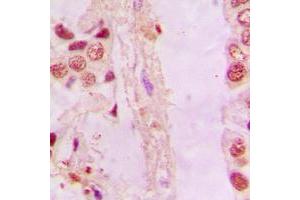 Immunohistochemical analysis of NRF2 staining in human lung cancer formalin fixed paraffin embedded tissue section. (NRF2 anticorps  (C-Term))