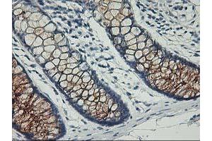 Immunohistochemical staining of paraffin-embedded Adenocarcinoma of Human ovary tissue using anti-PVRL1 mouse monoclonal antibody. (PVRL1 anticorps)