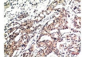 Immunohistochemical analysis of paraffin-embedded Human Breast Carcinoma Tissue using Ubiquitin Mouse mAb diluted at 1:200. (Ubiquitin anticorps)