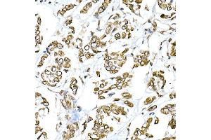 Immunohistochemistry of paraffin-embedded human breast cancer using Lamin A/C Rabbit pAb (ABIN6133798 and ABIN6143078) at dilution of 1:150 (40x lens). (Lamin A/C anticorps)
