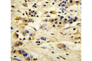 IHC analysis of FFPE human breast carcinoma stained with EIF4E2 antibody (EIF4E2 anticorps)