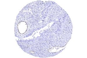 Ovary Serous high grade carcinoma showing distinct endothelial vWF staining in a subset of intratumoral vessels (Recombinant VWF anticorps  (AA 1815-1939))