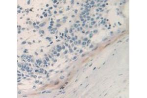 IHC-P analysis of Human Tissue, with DAB staining. (PSCA anticorps  (AA 22-95))