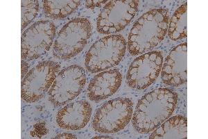 IHC analysis (400X) of CK19 expression in colon cancer, using CK19 antibody (1:1000 dilution). (Cytokeratin 19 anticorps  (full length))