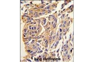 Formalin-fixed and paraffin-embedded human lung carcinoma tissue reacted with T1 antibody (C-term) (ABIN389117 and ABIN2839303) , which was peroxidase-conjugated to the secondary antibody, followed by DAB staining. (PPT1 anticorps  (C-Term))