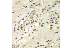 Immunohistochemistry of paraffin-embedded human kidney cancer using CHEK1 antibody (ABIN5975848) at dilution of 1/100 (40x lens). (CHEK1 anticorps)