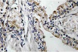 Immunohistochemistry (IHC) analyzes of VDR antibody in paraffin-embedded human prostate carcinoma tissue. (Claudin 7 anticorps)