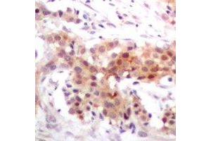 Immunohistochemical analysis of p300 staining in human breast cancer formalin fixed paraffin embedded tissue section. (p300 anticorps)