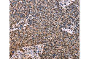 Immunohistochemistry of Human ovarian cancer using EVC2 Polyclonal Antibody at dilution of 1:40 (EVC2 anticorps)