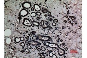 Immunohistochemical analysis of paraffin-embedded human-breast, antibody was diluted at 1:100. (HMGB1 anticorps  (acLys12))