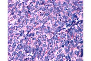 Anti-HTR1B / 5-HT2B Receptor antibody IHC of human Lung, Small Cell Carcinoma. (Serotonin Receptor 2B anticorps  (N-Term))