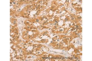 Immunohistochemistry of Human gastric cancer using CPB1 Polyclonal Antibody at dilution of 1:60 (CPB1 anticorps)
