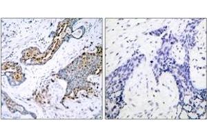 Immunohistochemistry analysis of paraffin-embedded human breast carcinoma, using Estrogen Receptor-alpha (Phospho-Ser118) Antibody. (Estrogen Receptor alpha anticorps  (pSer118))