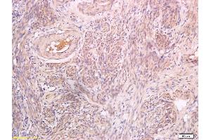 Formalin-fixed and paraffin embedded human endometrial carcinoma labeled with Anti-Inhibin beta B Polyclonal Antibody, Unconjugated (ABIN734993) at 1:200 followed by conjugation to the secondary antibody and DAB staining (Pro-Inhibin beta B (AA 251-350) anticorps)