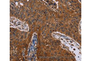 Immunohistochemistry of Human lung cancer using JUP Polyclonal Antibody at dilution of 1:40 (JUP anticorps)