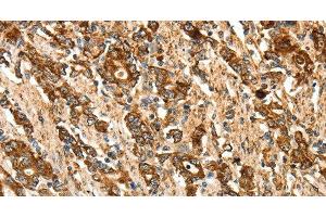 Immunohistochemistry of paraffin-embedded Human gastic cancer using CALR Polyclonal Antibody at dilution of 1:50 (Calreticulin anticorps)