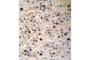 Formalin-fixed and paraffin-embedded human hepatocarcinoma tissue reacted with PCNA antibody , which was peroxidase-conjugated to the secondary antibody, followed by DAB staining. (PCNA anticorps  (AA 89-117))