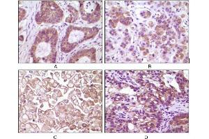 Immunohistochemical analysis of paraffin-embedded human colon carcinoma(A), breast carcinoma(B), kidney cell carcinoma(C), bladder carcinoma tumor(D), showing membrane and cytoplasmic localization using IKBKB mouse mAb with DAB staining. (IKBKB anticorps)