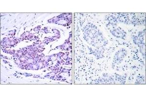 Immunohistochemistry analysis of paraffin-embedded human breast carcinoma tissue, using NF-kappaB p65 (Ab-468) Antibody. (NF-kB p65 anticorps  (AA 435-484))