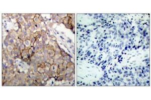 Immunohistochemical analysis of paraffin-embedded human breast carcinoma tissue using (EGFR anticorps)