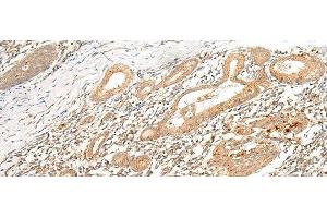 Immunohistochemistry of paraffin-embedded Human esophagus cancer tissue using HLA-G Polyclonal Antibody at dilution of 1:45(x200) (HLAG anticorps)