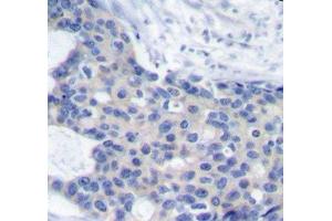 Immunohistochemistry of paraffin-embedded Human breast carcinoma tissue, using Phospho-ZAP70(Y493) Polyclonal Antibody (ZAP70 anticorps  (pTyr493))