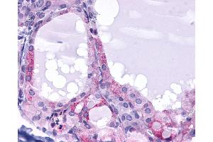 Anti-TSH Receptor / TSHR antibody IHC of human Thyroid, Follicular Carcinoma. (TSH receptor anticorps  (N-Term))