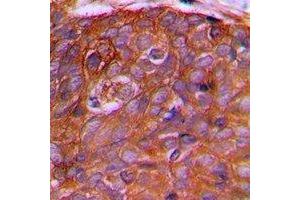 Immunohistochemical analysis of PEX2 staining in human prostate cancer formalin fixed paraffin embedded tissue section. (PEX2 anticorps  (N-Term))