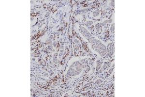 Immunohistochemical analysis of A on paraffin-embedded Human breast carcinoma tissue. (CDC25A anticorps  (pSer124))