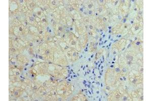 Immunohistochemistry of paraffin-embedded human liver cancer using ABIN7155441 at dilution of 1:100 (HIST1H4A anticorps  (AA 2-50))