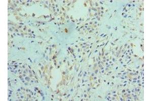 Immunohistochemistry of paraffin-embedded human breast cancer using ABIN7166400 at dilution of 1:100 (PAD4 anticorps  (AA 1-250))