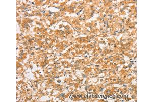 Immunohistochemistry of Human gastric cancer using TLR3 Polyclonal Antibody at dilution of 1:50 (TLR3 anticorps)